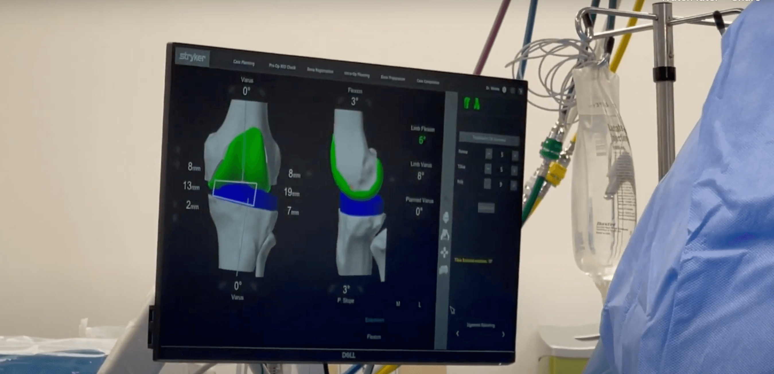 Mako Robotic Assisted Knee Replacement Denver Area